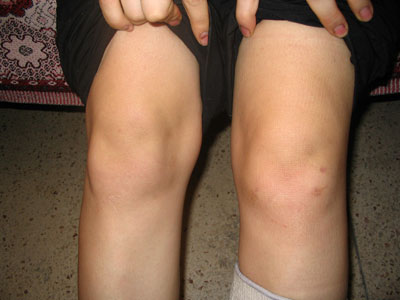 Когда необходима артроскопия коленного сустава?