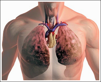 Рак лёгких и его ранняя диагностика