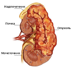 Фотография: Лечение и профилактика опухолей почки №1 - BigPicture.ru